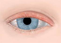 Eye showing inflamed upper eyelid.