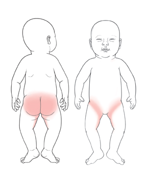 Front and back views of baby showing common areas for daiper rash to form. 