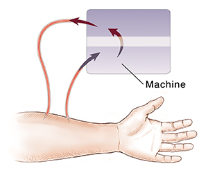 Closeup of arm showing path of blood going through catheters to and from machine for hemodialysis.