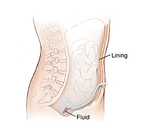 Side view of abdomen showing catheter inserted through abdominal lining into abdominal cavity.